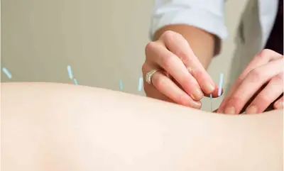 Akupunktur-Polyneuropathie